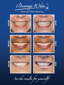 Teeth Whitening Posters