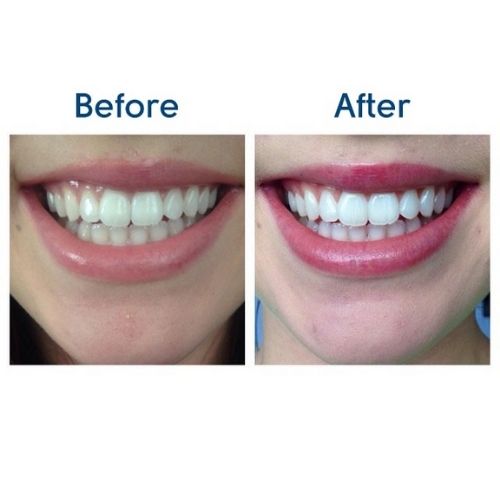 Deluxe Home Teeth Whitening Kit 36 CP - Before and After