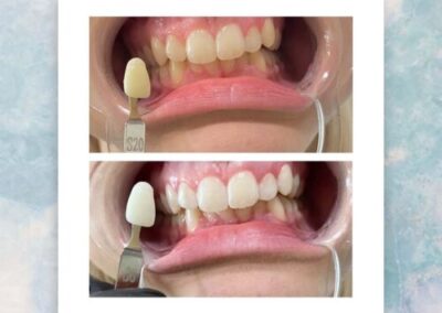 tooth shade 20 to 6