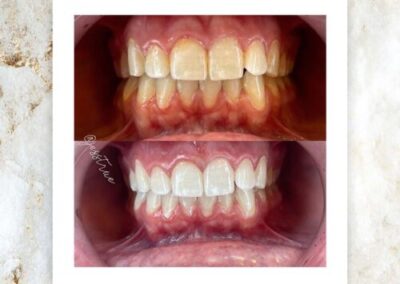 whiten teeth shade 22 to 6