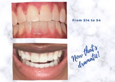 real teeth whitening results shade 14 to 4